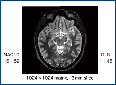 図2　PD STIR画像における10回加算とDLRの比較（W.I.P.）