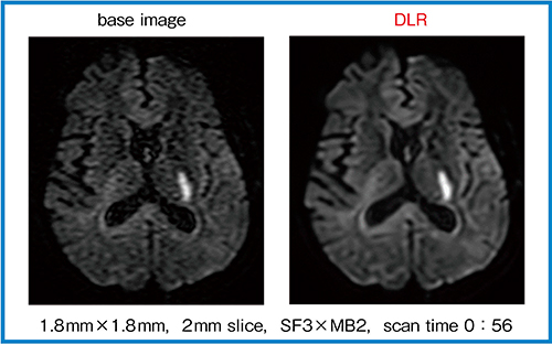 図3　DWI（b=1000，1direction）におけるDLRの効果（W.I.P.）