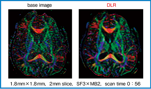 図4　DTIカラーマップにおけるDLRの効果（W.I.P.）