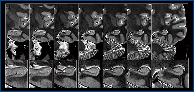 図3　Galan ZGOによる海馬の内部構造および多発性硬化症の描出（W.I.P.）