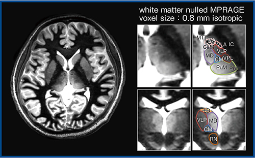 図5　SNRを最適化したGalan ZGOによる視床核の輪郭特定（W.I.P.）