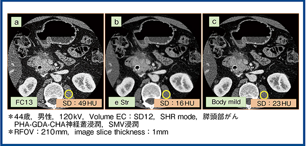 図6　FBP法（a），AIDR 3D（b），FIRST（c）の症例画像