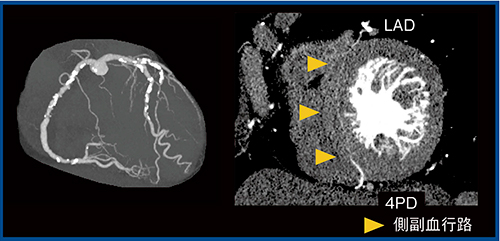 図9　LADから4PDへの側副血行路の描出