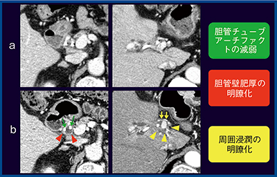 図4　症例3：肝門部領域胆管がん，ERBD後（70歳代，男性） a：MDCT（1mm）　b：Aquilion Precision（1mm）