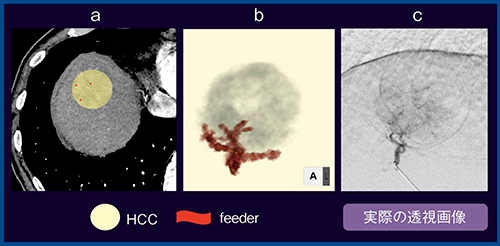 図8　症例7：S8，50mm大HCC（80歳代，男性） a：Aquilion Precision　b：VR画像　c：透視画像