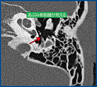 図3　Aquilion Precisionで描出されるあぶみ骨筋腱（0.25mm厚）