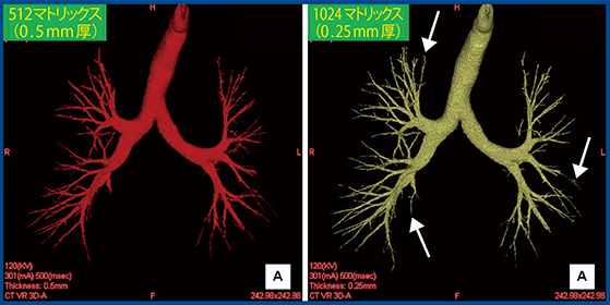 図6　ザイオソフト社のソフトウエアを用いた1024マトリックスデータでの気管支抽出 Aquilion Precisionで撮影した生データから2種類の画像を作成（再構成）した。従来CTと同じように再構成した，0.5mm・512マトリックスデータでは自動抽出されない気管支が，0.25mm・1024マトリックスデータでは多数抽出されている。
