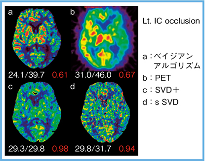 図4　左内頸動脈閉塞症例のCT perfusion解析結果