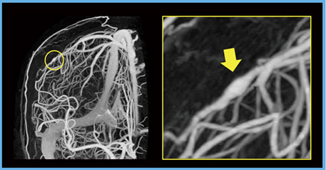 図3　感染性動脈瘤