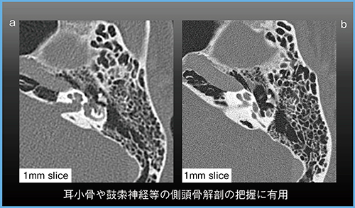 図2　Aquilion Precisionによる側頭骨の描出 a：従来CT　b：超高精細CT