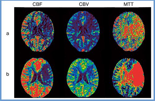 図1　症例1：灌流画像 a：sSVD　b：ベイジアンアルゴリズム