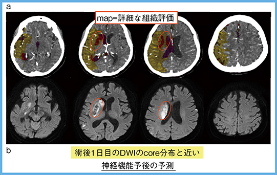 図4　症例2：サマリーマップ（a）と術後DWI（b）