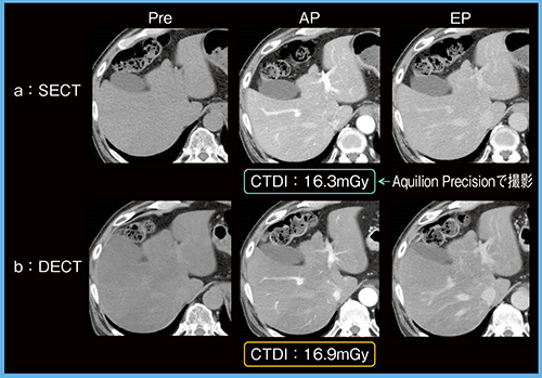 図1　症例1：SECT（Aquilion Precision）とDECTの画像比較