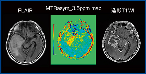 図3　FFEEPI3DによるMTRasym_3.5ppm map（膠芽腫）