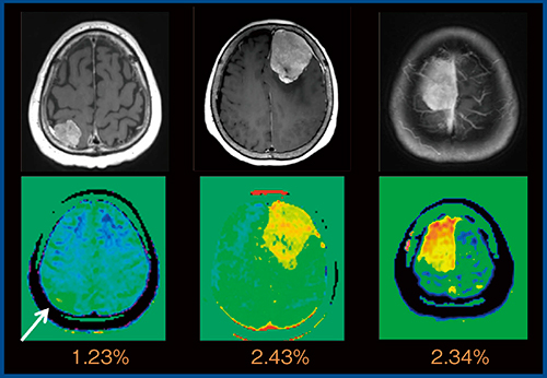 図6　Meningioma（WHO gradeⅠ）のMTRasym_3.5ppm map