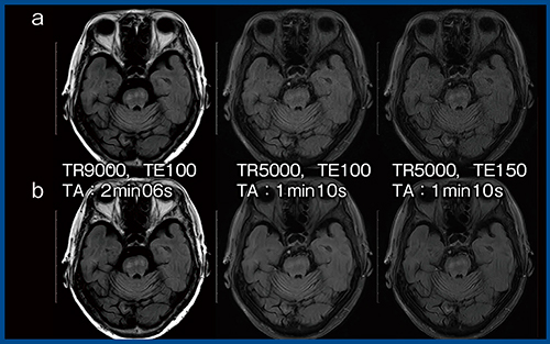図3　AiCEによるFLAIRの撮像時間の短縮（多発性硬化症） a：AiCEなし　b：AiCEあり