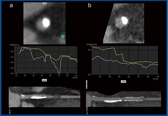 図5　Aquilion Precisionによる石灰化病変の評価 a：従来CT　b：Aquilion Precision