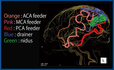 図6　症例5：脳動静脈奇形（AVM）