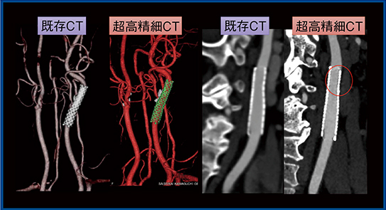 図7　症例3：頸部動脈ステント留置術（CAS）（73歳，男性）