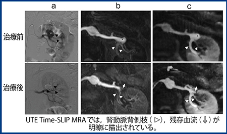 図3　臨床例：腎動脈瘤に対するコイル塞栓後 a：DSA　b：bSSFP Time-SLIP　c：UTE Time-SLIP