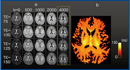図3　Vantage Galan 3Tにおけるパラメータの設定範囲の拡大 a：b値およびTEを変化させた画像 b：intra-axonal compartmentのT2 10）