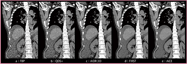 図1　8.7mGyで撮影した腹水貯留のある症例のコロナル画像（症例1）