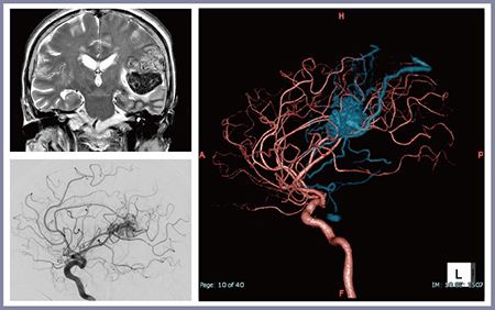 図2　症例2：左頭頂葉のAVM