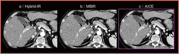 図1　腹部高精細CTにおけるAiCEによる画質向上3）