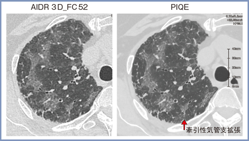 図6　間質性肺炎：急性増悪