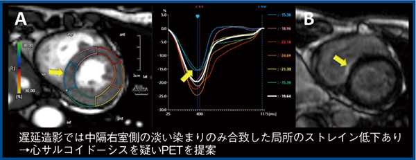 図3　心サルコイドーシスへの応用（参考文献5）より引用転載）