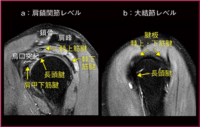 図3　脂肪抑制T2強調画像，矢状断