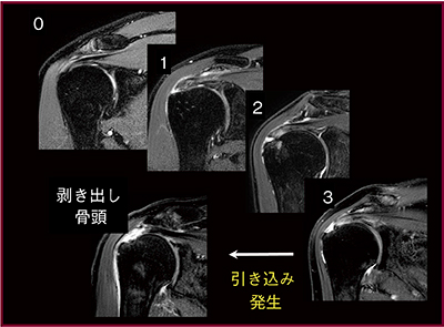 図6　引き込み現象