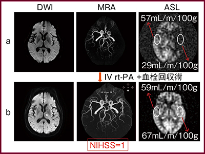 図1　治療前後のMR画像 a：治療前　b：治療後