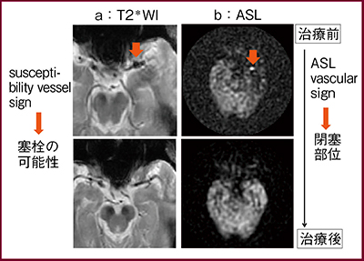 図2　治療前後のMR画像：血栓部位の診断