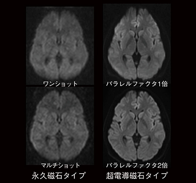 図6　DWI画像の違い