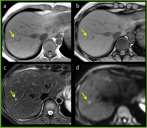 図2　転移性肝腫瘍症例の通常シーケンス画像 a：in phase　b：out-of-phase c：T2WI　d：DWI（b=1000）