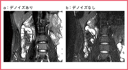 図3　デノイズ処理による回腸末端の病変のコントラスト向上（参考文献7）より引用転載）