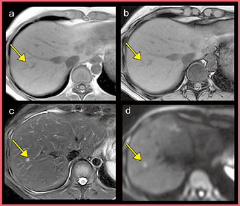 図1　転移性肝腫瘍症例のルーチン検査画像 a：in phase　b：out-of-phase c：T2強調画像　d：DWI（b=1000s/mm2）