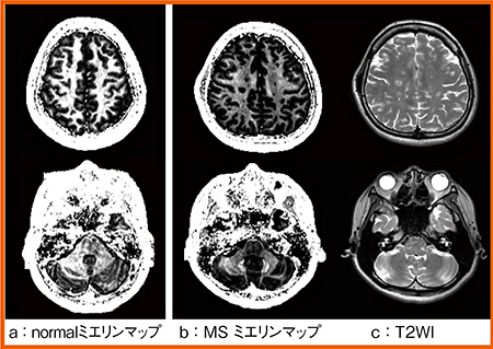 図1　症例1：ミエリンマップとT2強調画像