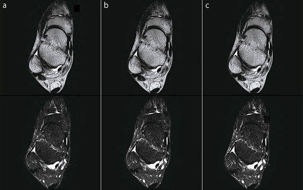 図7　足関節FatSep T2WI（上段：in Phase画像，下段:脂肪抑制画像） a：IP-RAPID off, Phase=1.5, Freq/Phase=320×288, scan time=2:55 b：IP-RAPID on, Phase=2.0, IP-Recon=Light, Freq/Phase=320×288, scan time=2:12 c：IP-RAPID on, Phase=2.7, IP-Recon=Medium, Freq/Phase=320×288, scan time=1:35