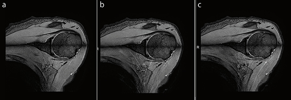 図8　肩関節Radial Stack T2＊WI a：IP-RAPID off, Phase=1.2, Freq/Phase=224×224, scan time=3:08 b：IP-RAPID on, Phase=1.5, IP-Recon=Light, Freq/Phase=224×224, scan time=2:31 c：IP-RAPID on, Phase=2.0, IP-Recon=Medium, Freq/Phase=224×224, scan time=1:54