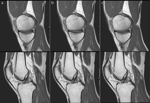 図10　膝関節PDWI a：IP-RAPID off, Phase=1.6, Freq/Phase=288×288, scan time=2:58 b：IP-RAPID on, Phase=1.8, IP-Recon=Light, Freq/Phase=320×320, scan time=2:58 c：IP-RAPID on, Phase=2.0, IP-Recon=Medium, Freq/Phase=352×352, scan time=2:56