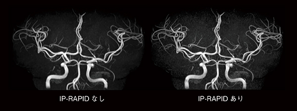 図5　同じ撮像時間（4分）におけるMRAの比較 IP-RAPIDの使用により短くなった撮像時間をスライス厚やマトリックスに利用することで，高分解能MRAを得ることができる。