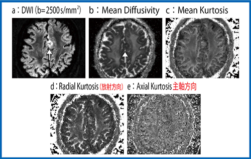 図5　症例2：拡散の変化