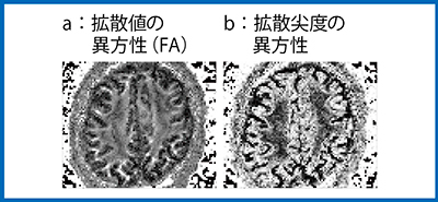 図6　症例2：拡散値（FA），拡散尖度の異方性