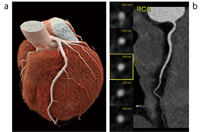 SOMATOM X.citeの症例画像〔自動処理された3D画像（a）とCPR画像（b）〕