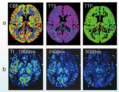 図5　症例3：CTPとMRP（ASL）の比較 a：CTP（Definition Flash） b：ASL（MAGNETOM Skyra）