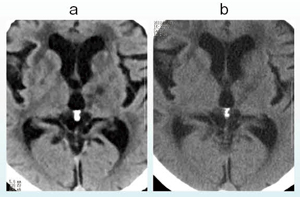 図6　SAFIREを用いた陳旧性視床梗塞の描出 a：64列MDCT with SAFIRE b：他社製16列MDCT