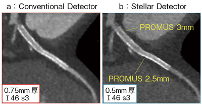 図4　Stellar Detector（b）によるステントの描出