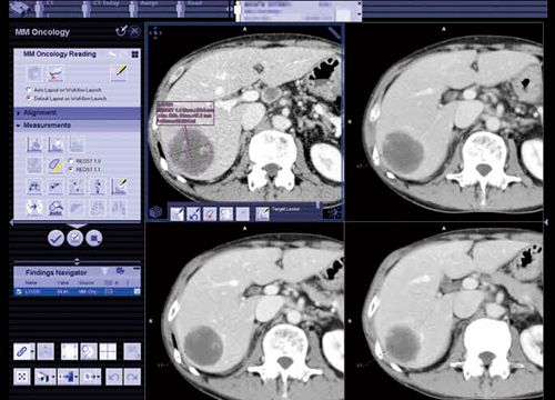 図5　MM Oncology 肝転移症例のAuto Segmentation